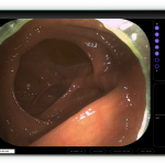 Neptune Medical Triton 1. A robot steadies the colonoscope and wins FDA clearance