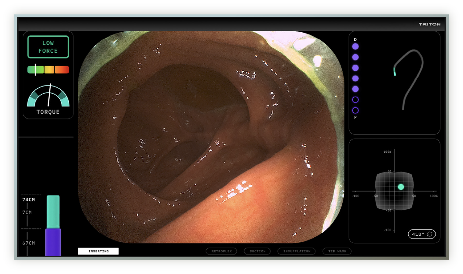 Neptune Medical Triton 1. A robot steadies the colonoscope and wins FDA clearance